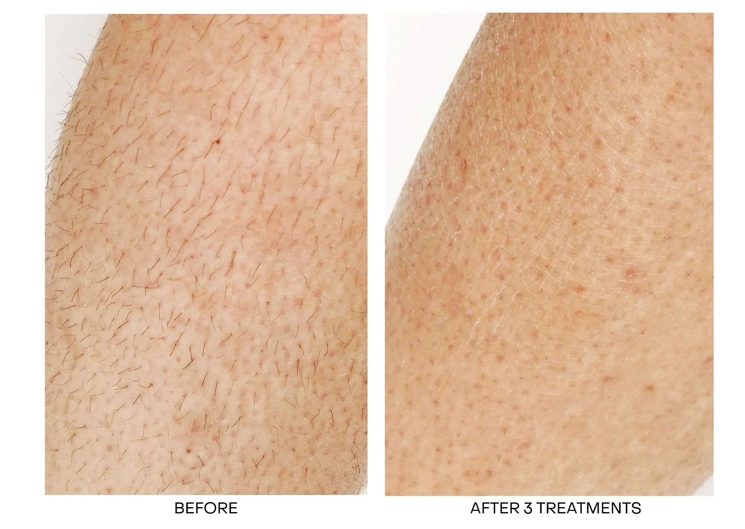 laser hair removal ajax