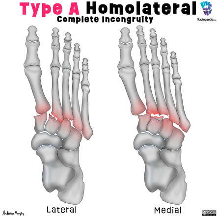 lisfranc fracture radiology