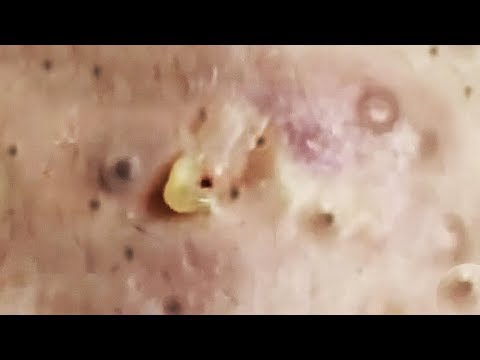 pimple popping videos on youtube