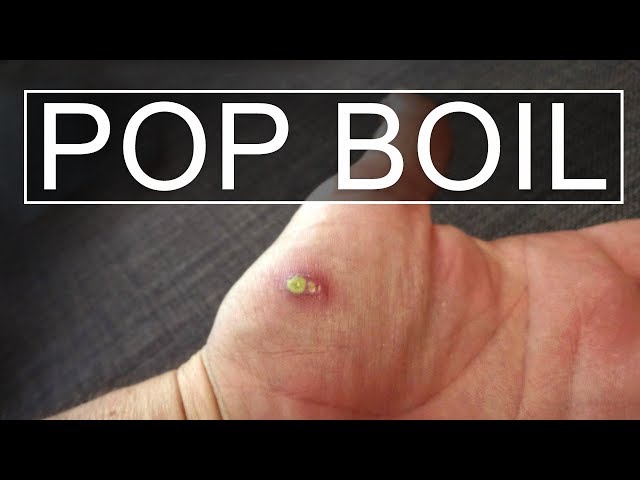 popping massive boils