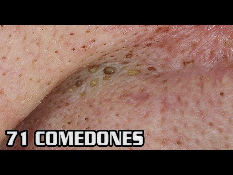 popping zits on youtube