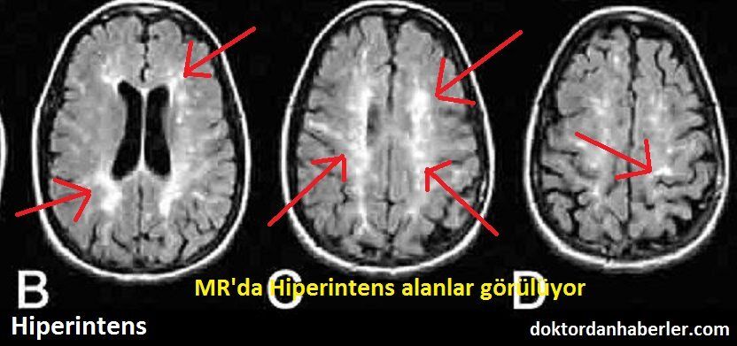 t2 flair hiperintens