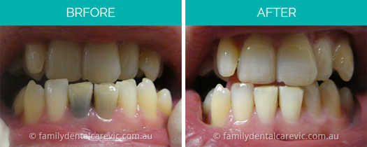 teeth bleaching doncaster east