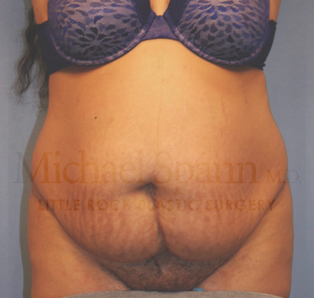 tummy tuck arkansas