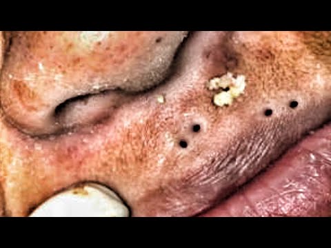 youtube zit popping